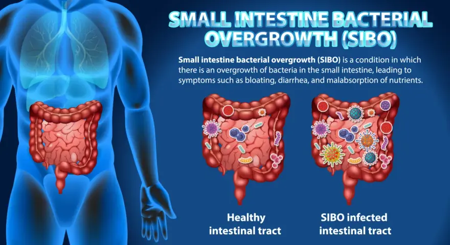 Illustration comparant un intestin sain et un intestin infecté par SIBO, montrant les symptômes de la prolifération bactérienne.