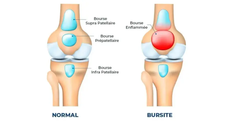 Comparaison d'un genou normal et d'un genou atteint de bursite. La bourse prépatellaire est enflammée et gonflée, causant un genou gonflé.