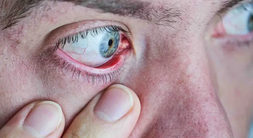 Gros plan sur un œil humain présentant un orgelet rouge sur la paupière. Une main touche doucement la zone, suggérant une recherche d'orgelet traitement naturel.