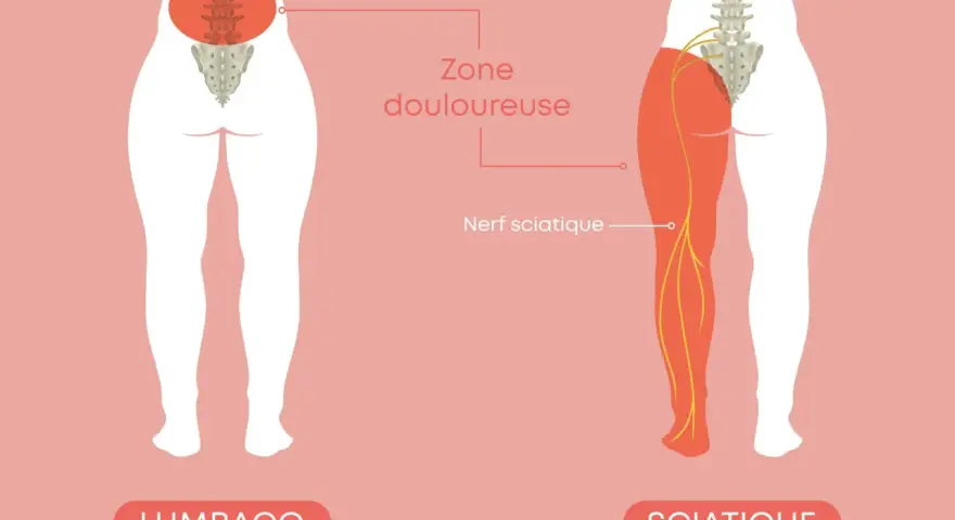 Illustration montrant le nerf sciatique et la zone douloureuse. Comprendre comment soigner une sciatique est essentiel pour retrouver le confort.