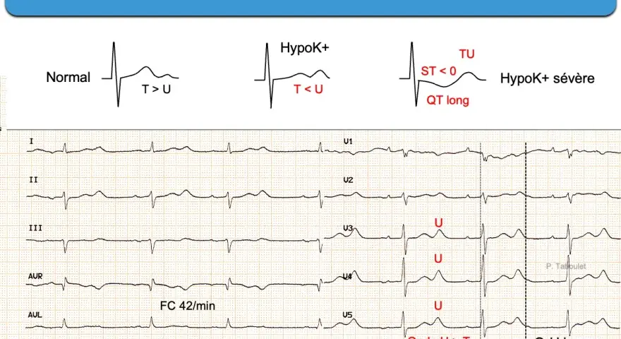 Électrocardiogramme montrant une hypokaliémie sévère avec onde U > T et QT long, signes d'un manque de potassium.
