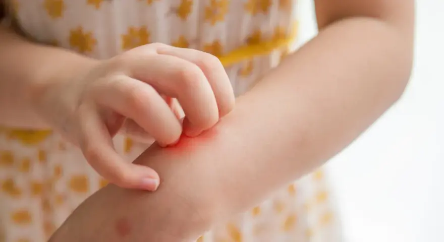 Main d'enfant se grattant le bras, une rougeur indiquant une piqûre de moustique qui gratte longtemps.