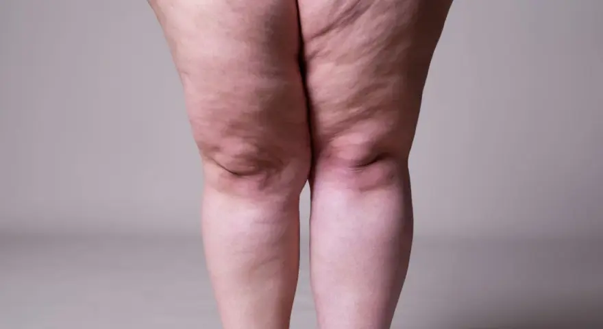 Jambes présentant des signes de lipœdème, évoquant la recherche d'un lipœdème traitement naturel.