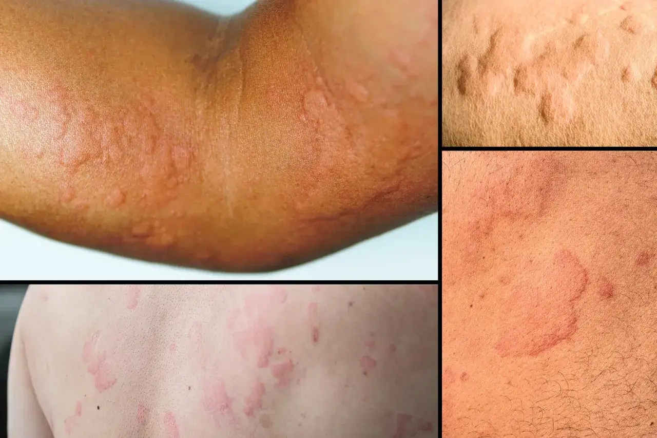 Rougeurs et boutons sur la peau, montrant des r&eacute;actions cutan&eacute;es. Recherche d'urticaire traitement naturel pour apaiser ces sympt&ocirc;mes.