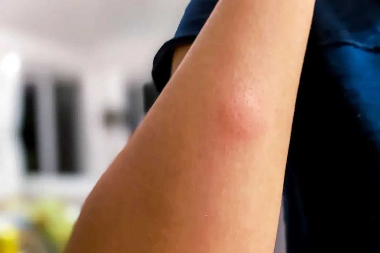 Un bras avec une rougeur et un petit bouton, signe d'une piq&ucirc;re de moustique qui gratte longtemps.