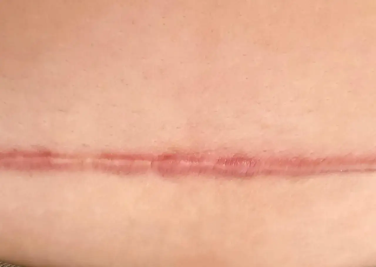 Gros plan sur une cicatrice hypertrophique rouge et surélevée sur une peau claire, témoignant d'une guérison cutanée intense.