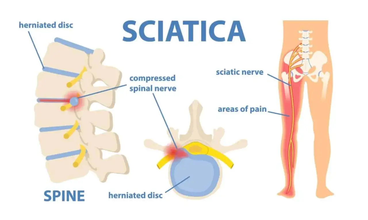 Schéma expliquant comment soigner une sciatique : hernie discale comprimant le nerf sciatique, causant des douleurs irradiant dans la jambe.