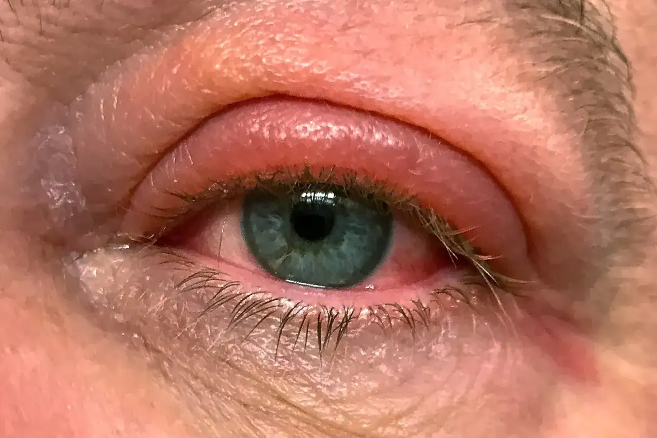 Un orgelet cause fatigue et rougeur sur la paupi&egrave;re. L'&oelig;il est irrit&eacute;, le regard fatigu&eacute;.