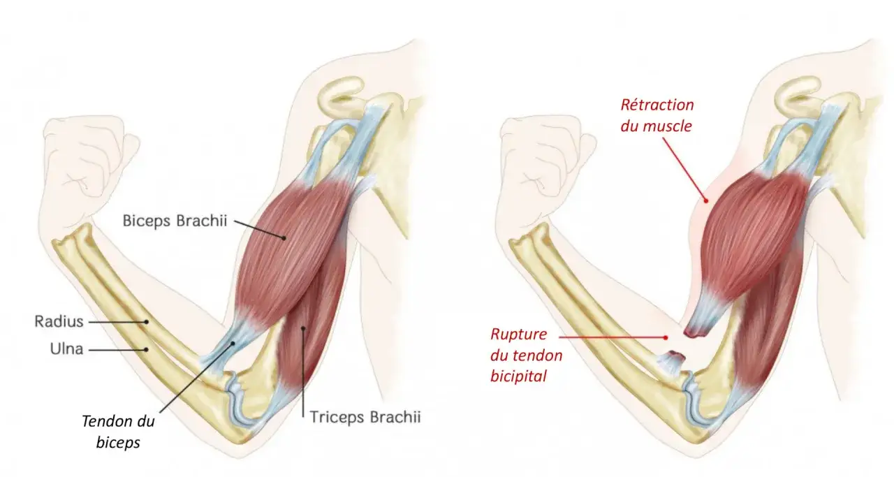 Comparaison d'un bras sain et d'un bras avec rupture du tendon bicipital, illustrant la rétraction du muscle due à une tendinite au bras.