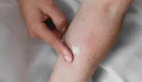 Application d'une crème apaisante sur une peau irritée, suggérant un urticaire traitement naturel.