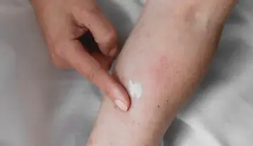 Application d'une crème apaisante sur une peau irritée, suggérant un urticaire traitement naturel.