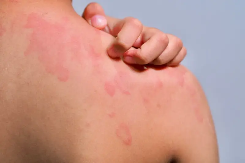 Une personne se gratte l'épaule couverte de plaques rouges, signe d'urticaire chaleur.