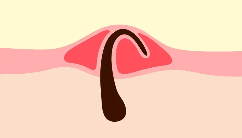 Illustration d'un poil incarné sous la peau, avec une partie foncée courbée sous une couche rose.